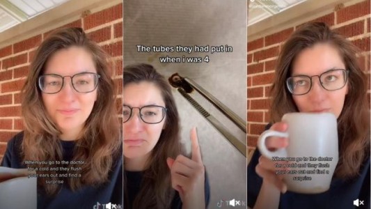 Fue al médico por un resfriado y le sacaron del oído un objeto que llevaba 22 años allí