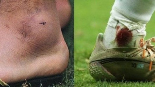 La impactante foto del tobillo maradoniano de Messi en el partido contra Colombia