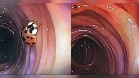 Descubrieron que un hombre tenía a una vaquita de San Antonio viviendo en el intestino