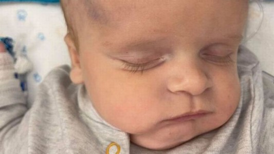 Un bebé recién nacido quedó con daño cerebral tras procedimiento durante el parto: usaron un clip de electrodo