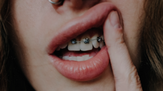 La peligrosa moda de los brackets falsos que se difunde por las redes sociales
