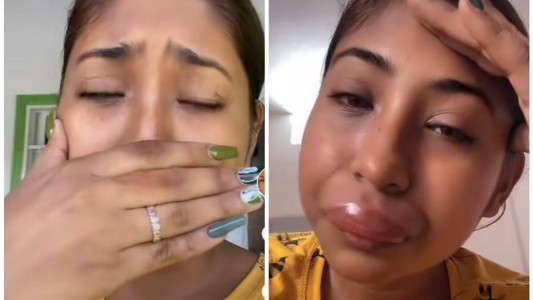 Video: una chica se volvió viral al mostrar cómo le quedaron los labios tras la picadura de una abeja