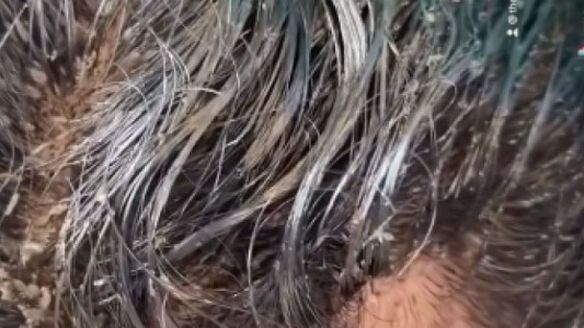 Video escalofriante: la nena que tuvo que ir al hospital porque tenía 15.000 piojos en la cabeza
