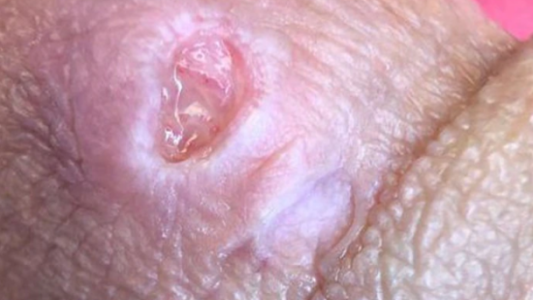 Suben los contagios en Reino Unido de una bacteria "comecarne" de transmisión sexual