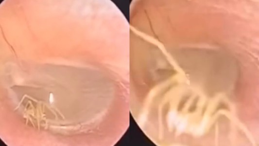 VIDEO: así descubrieron una araña que anidó en el oído de una mujer