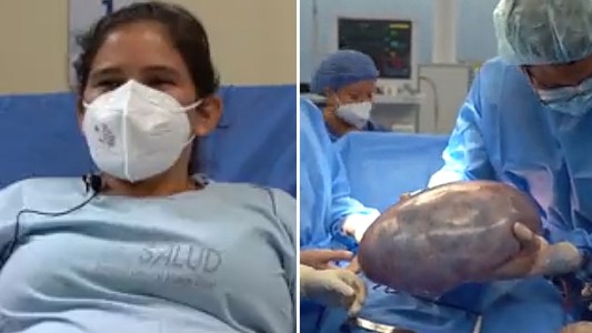 Le sacaron un tumor gigante de 6 kilos a una mujer: "Amenazaba su vida"