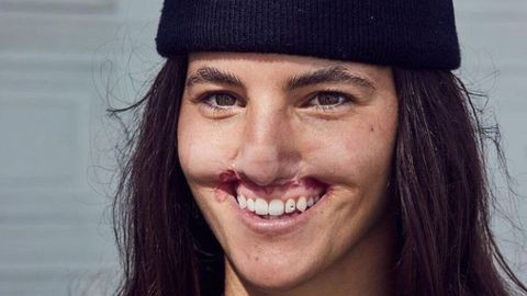 La modelo que se operó para recuperar el labio que perdió al ser atacada por un perro