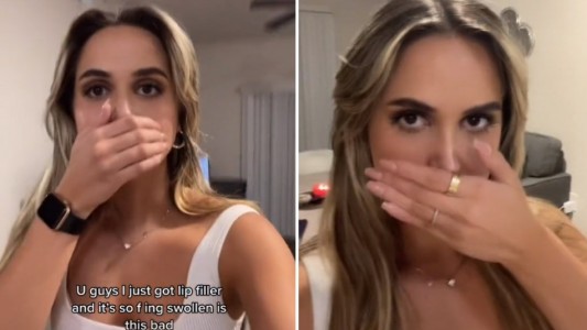 Video viral: una influencer se operó los labios y el resultado asustó a sus seguidores