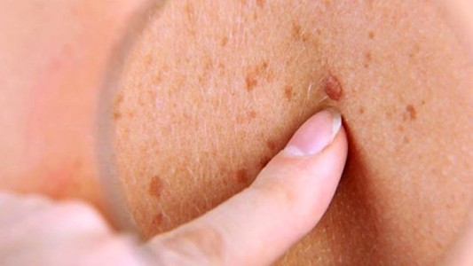 El cáncer de piel es el más común luego de los 40 años