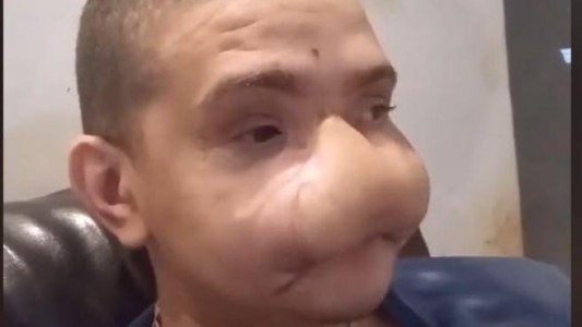 El drama del joven brasileño con la cara desfigurada por culpa de los fuegos artificiales