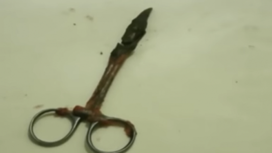 Le sacaron una tijera del estómago tras 20 años: sufría fuertes dolores abdominales