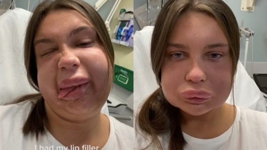La joven tiktoker que tuvo alergia tras realizarse un relleno de labios: en las redes la compararon con Homero Simpson