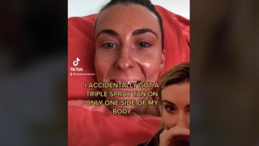 Así quedó una mujer tras una sobredosis de spray de bronceado