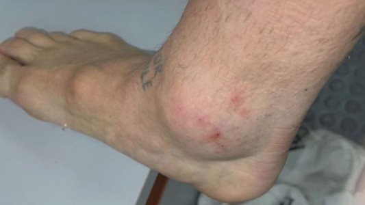 La impactante foto del tobillo del "Papu" Gómez tras el duelo con Chile