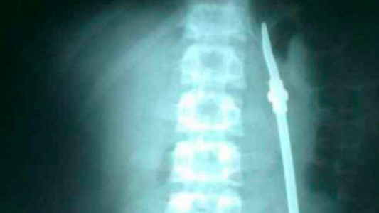 Un preso se tragó una bombilla, lo llevaron al hospital para operarlo y aprovechó para fugarse