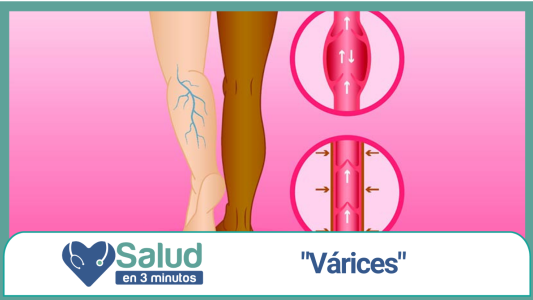 Mitos y verdades acerca de las várices