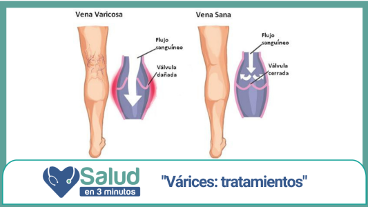 Tratamientos para várices