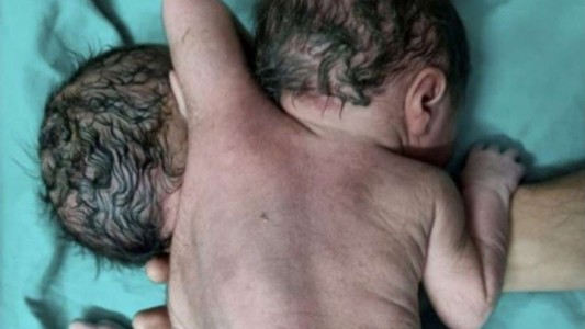 Les dijeron que esperaban mellizos: nació un bebé con dos cabezas