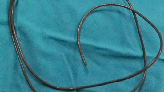 No podía orinar y lo que encontraron en su vejiga sorprendió a los médicos: “Lo hacía por placer sexual”