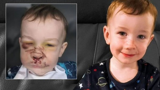 Un perro bull terrier le destrozó la cara de un mordisco a un bebé