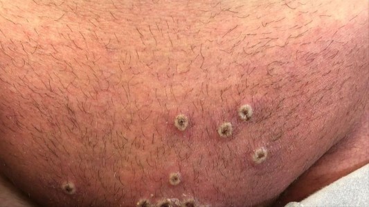 Primer caso de viruela de mono en América