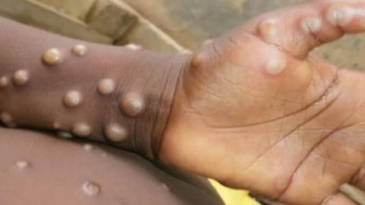 Cómo se contagia la viruela del mono en los humanos y cuáles son sus síntomas