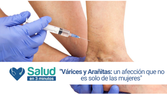 Várices y Arañitas: una enfermedad venosa que no es exclusiva de las mujeres