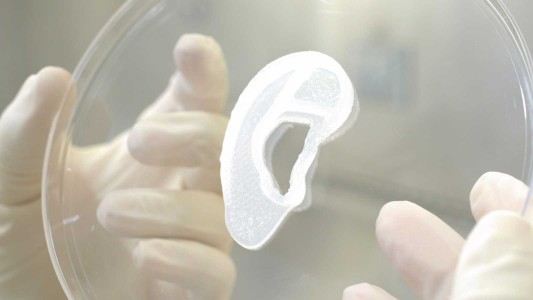 Implantan oreja impresa en 3D a partir de células humanas