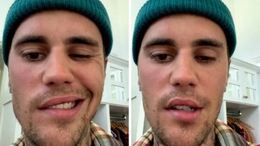 Justin Bieber, afectado por parálisis facial: cómo es esa dolencia