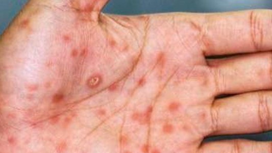 Reino Unido: quieren vacunar contra la viruela del mono a gays "de riesgo"