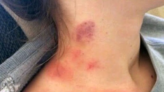 Una maestra descubrió que una niña era abusada por su padrastro en Orán por una marca en el cuello