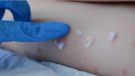 Confirman el primer caso de viruela del mono en Mendoza