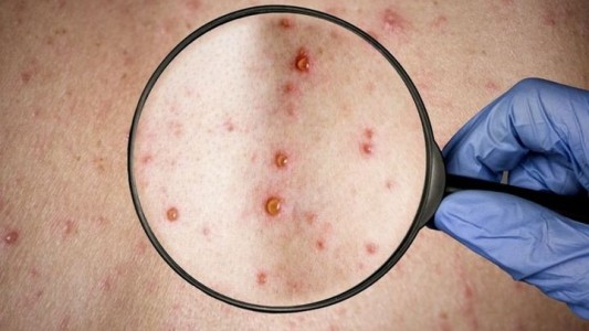 Viruela del mono: se confirmó un caso en Córdoba