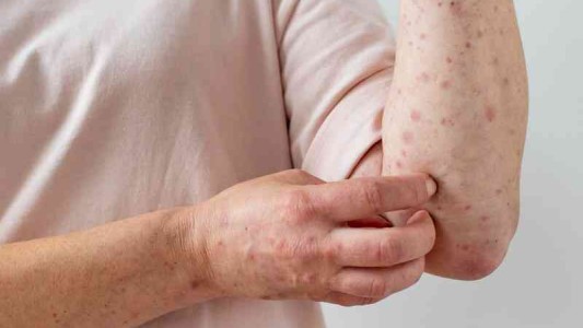 La OMS confirmó más de 5.000 casos de viruela del mono en el mundo