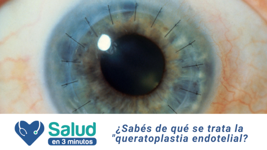 Transplante endotelial, cuando la cornea empieza a descompensarse