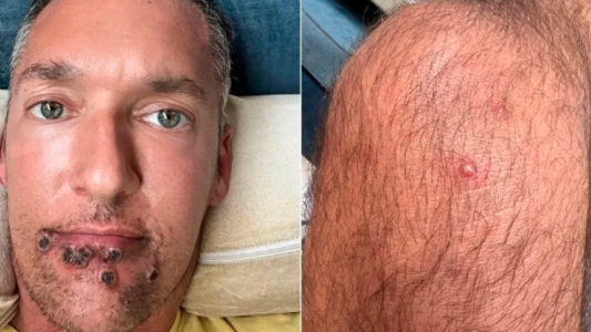 Un actor porno mostró las heridas tras contagiarse de viruela del mono