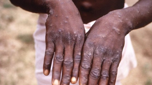 Viruela del mono: la OMS advirtió que la vacuna no alcanza para detener los contagios