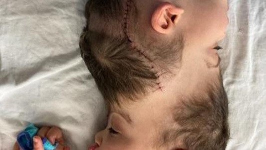 Con ayuda de realidad virtual, separaron con éxito a siameses unidos por la cabeza