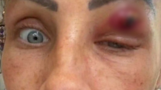 Mujer creyó que tenía un grano en su párpado pero terminó expulsando un parásito