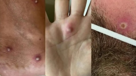 Primer caso en el mundo: fue al hospital con síntomas dio positivo de Covid, viruela del mono y VIH