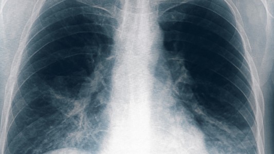 Ocho nuevos casos de neumonía bilateral por legionella en Tucumán