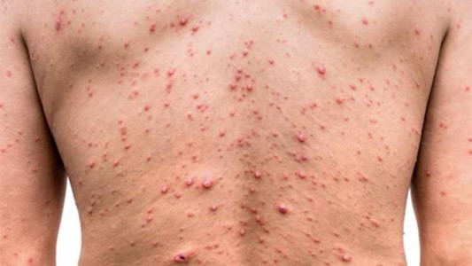 China registró un primer caso de viruela del mono en Chongqing