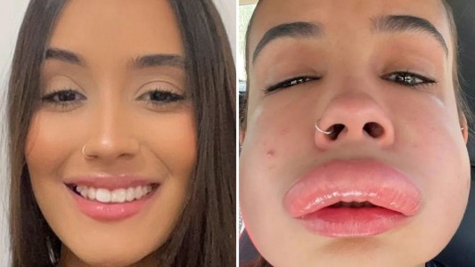 "¿Qué hice?": el susto de una joven de 20 años tras el fallido intento de rellenarse los labios