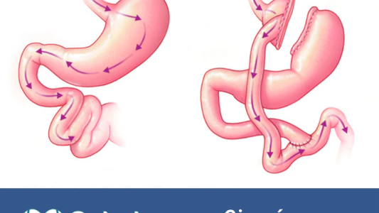 OBESIDAD: Cirugía Bariátrica