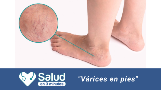 Varices de los pies