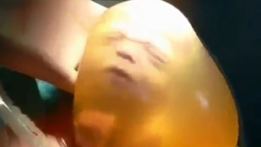 Parto velado en Rosario: ocurre uno cada 80 mil nacimientos