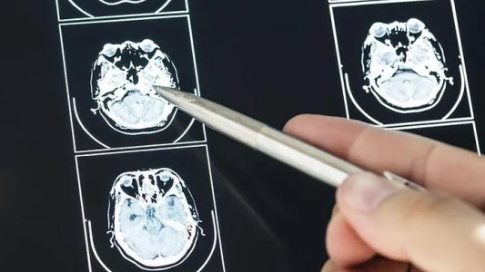 Cada día se detectan en Argentina 5 casos de tumores cerebrales: ¿cuáles son los signos de alerta?