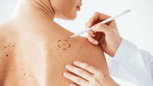 Lunares y cáncer de piel: cinco signos de alerta para consultar a un médico