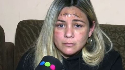 La balearon en un robo, tiene el proyectil en la cabeza y tiene miedo: “Voy a vivir encerrada”