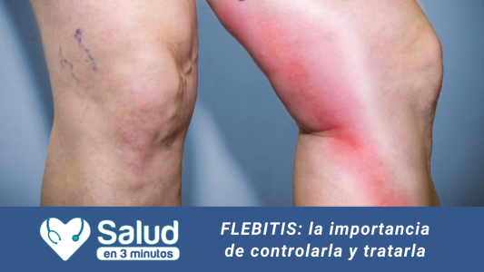 Flebitis: La importancia de un diagnóstico acertado por profesionales médicos